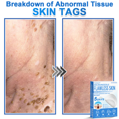 Awzlove® 2-in-1 Microneedle & Hydrocolloid Patch | Raised Moles,Acne,  Flat Warts & Skin Tags Remover | Improves Wrinkles, Scars & Blemishes | Invisible Star Pimple Patches for Face & Body |🎄🌳1
