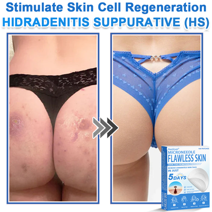 Awzlove® 2-in-1 Microneedle & Hydrocolloid Patch | Raised Moles,Acne,  Flat Warts & Skin Tags Remover | Improves Wrinkles, Scars & Blemishes | Invisible Star Pimple Patches for Face & Body |🎄🌳1
