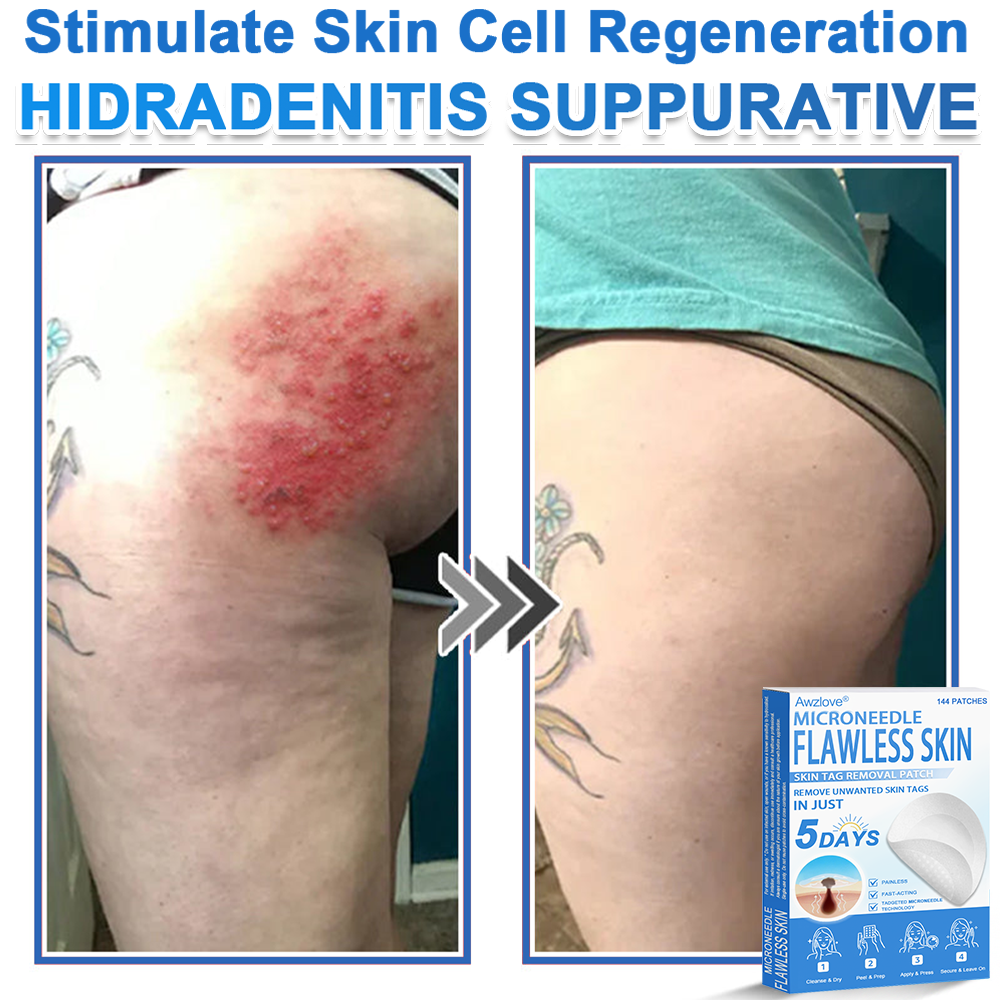 Awzlove® 2-in-1 Microneedle & Hydrocolloid Patch | Raised Moles,Acne,  Flat Warts & Skin Tags Remover | Improves Wrinkles, Scars & Blemishes | Invisible Star Pimple Patches for Face & Body |🎄🌳1