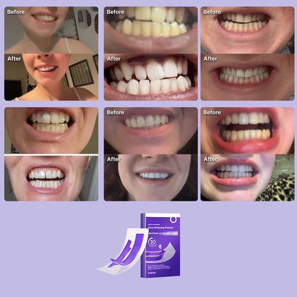 [🔥 Annual Sale]Healrize® Purple Whitening Strips, Your teeth will shine brighter than ever before.