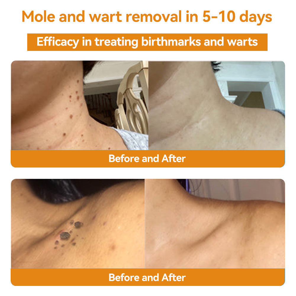 Turonu™ Bee Venom Skin Treatment Cream British Association of Dermatologists (BAD) Approved(Helping with acne, wart, rosacea, psoriasis, age spots, eczema, and reducing the appearance of stretch marks)🏵️