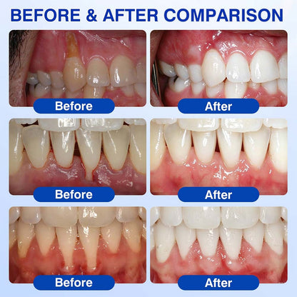 🧑‍⚕️Healrize® GumRevive gel for the regeneration of the tooth-supporting apparatus (for bleeding gums, receding gums, and loose teeth) 🦷