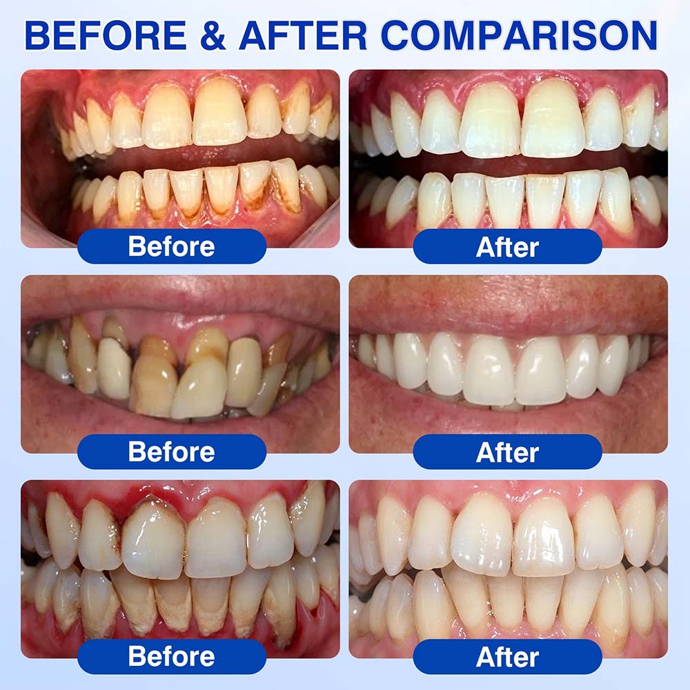 🧑‍⚕️Healrize® GumRevive gel for the regeneration of the tooth-supporting apparatus (for bleeding gums, receding gums, and loose teeth) 🦷