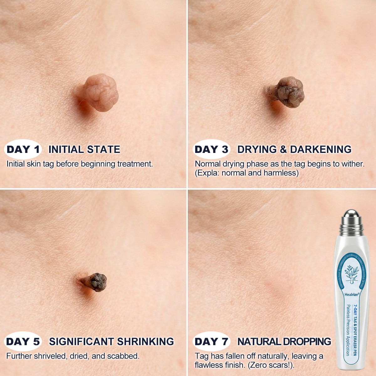 𝐇e𝐚𝐥𝐫i𝐳e® 7-𝐷𝑎𝑦 𝗧𝐚𝐠 & 𝗦𝗽𝐨𝐭 𝐄𝐫𝒂𝒔𝒆𝒓(Zero Pain, Zero 𝐒𝐜𝐚𝒓𝒔 Rollerball)🎄🌳3
